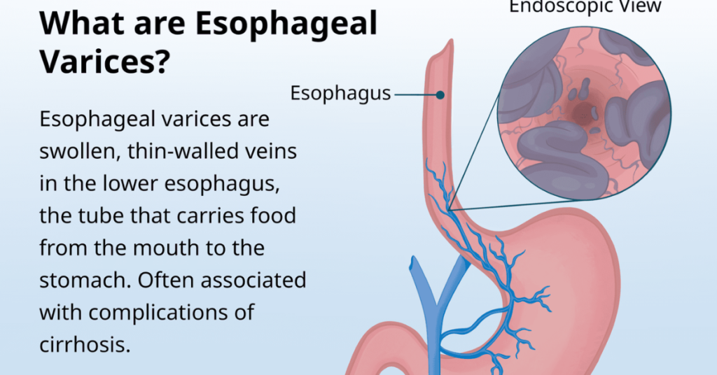 This method is particularly useful to prevent the possibility of bleeding within the oesophagus or when someone 