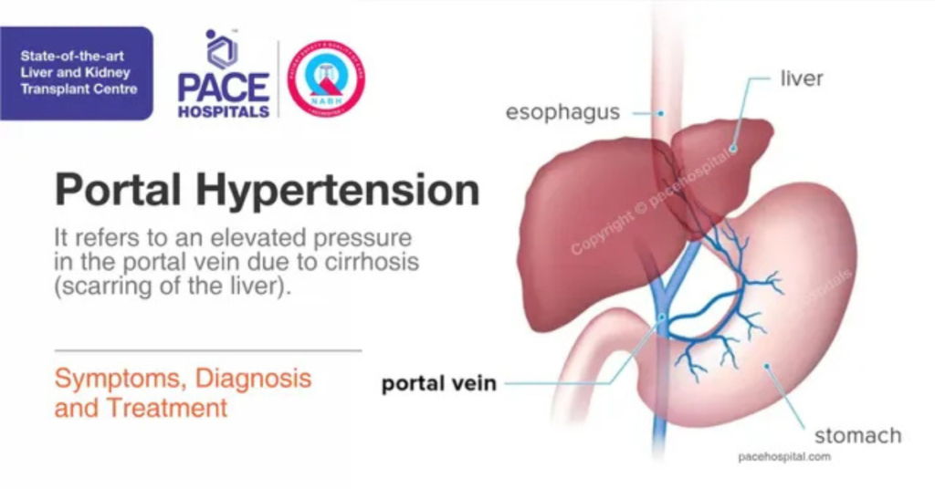 Varices in Oesophagus:
