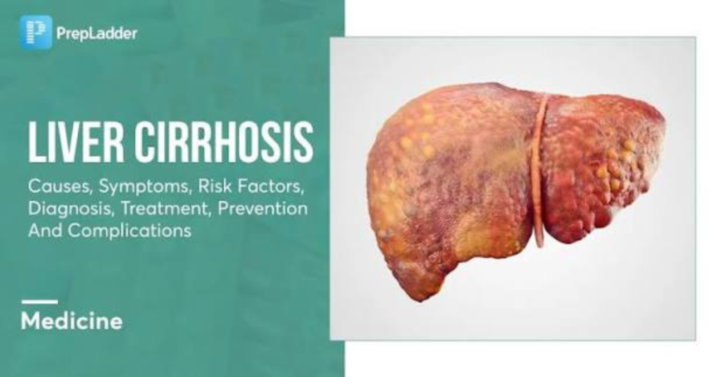Varices in Oesophagus:
