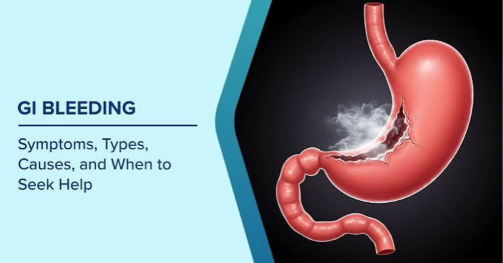 Upper GI Bleed:
