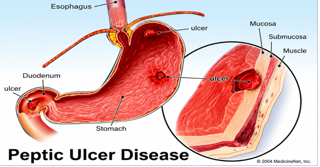 Upper GI Bleed:
