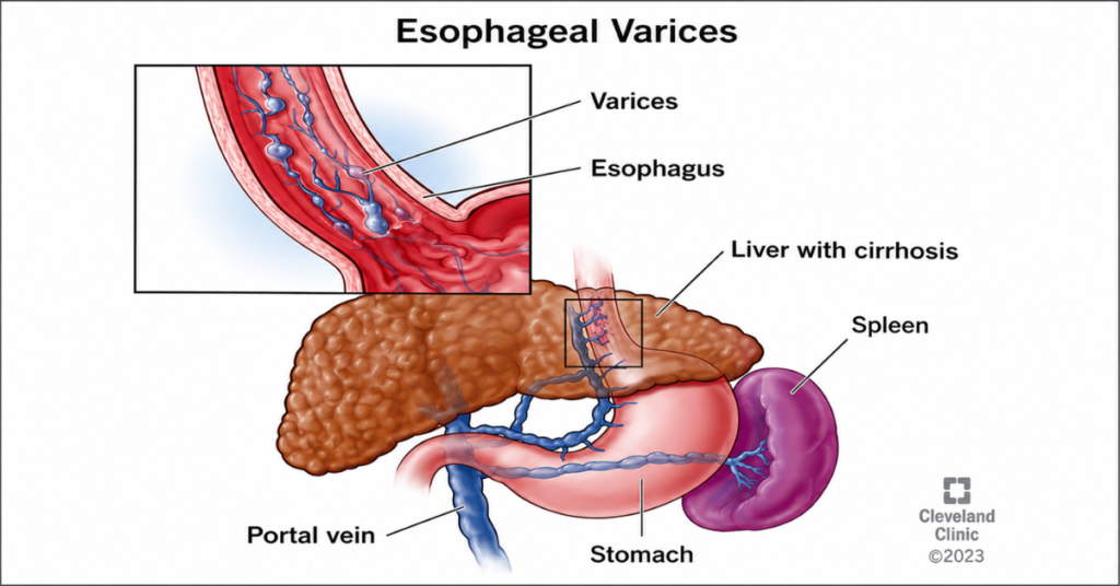 Upper GI Bleed:
